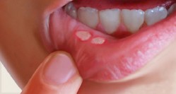 درمان سریع آفت دهان با پیاز خام