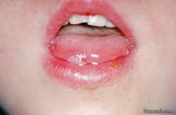 درمان آفت دهان با دارویی جدید در 20 ثانیه