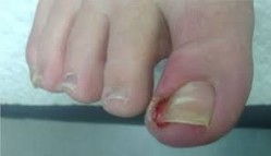 درمان سریع خانگی عفونت ناخن فرو رفته در گوشت انگشت پا